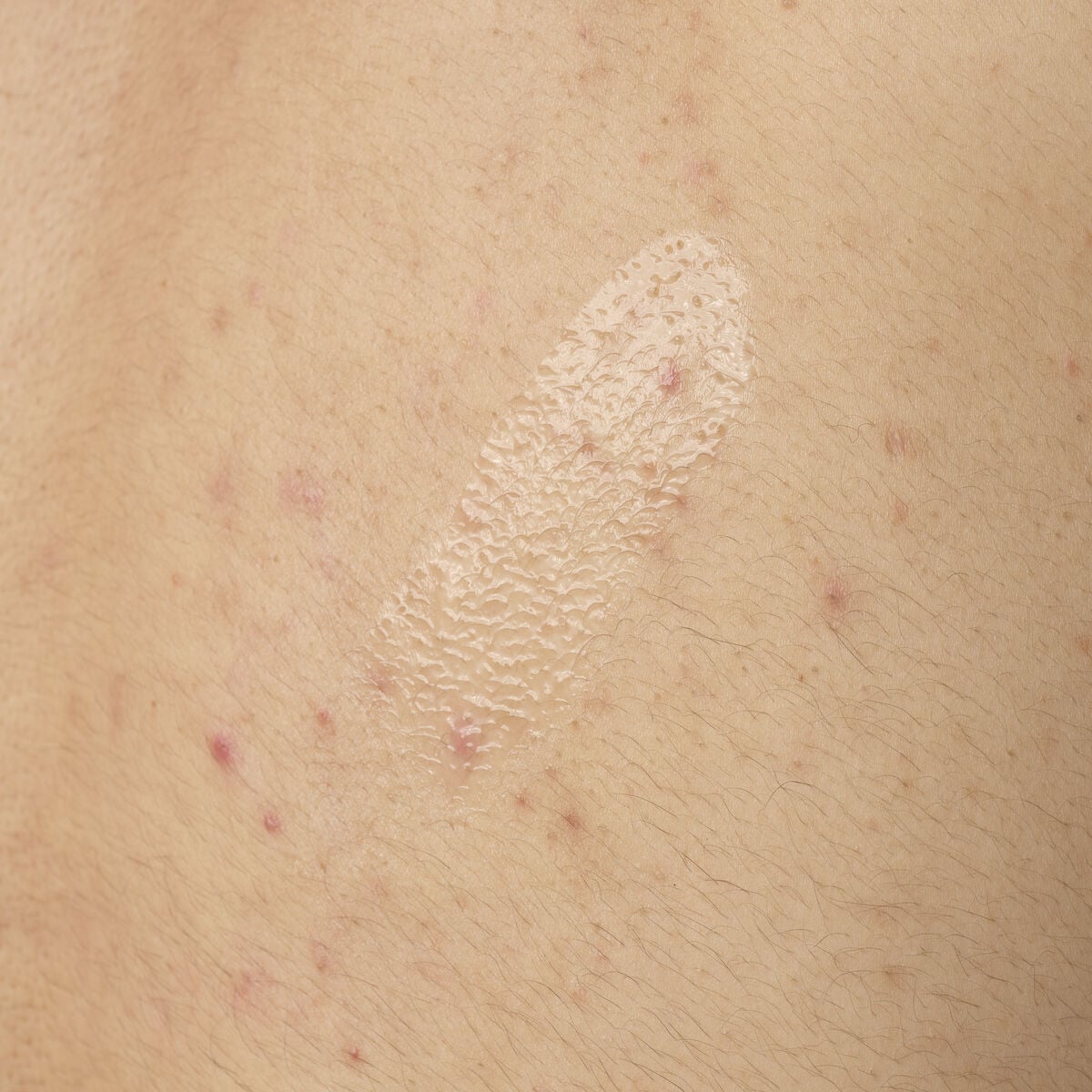salicylic-acid-0-5-body-serum-g9 ORD-salicylic-acid-05-body-240ml-application.jpg