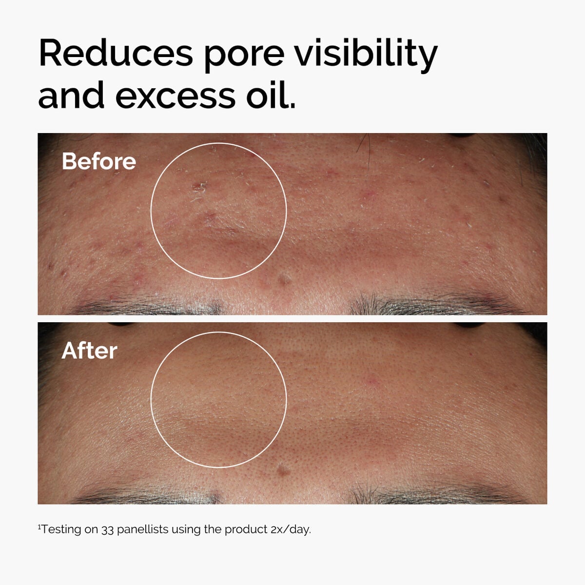 niacinamide-10-zinc-1-x5 ord-niacinamide-zinc-blemish-serum-before-after-pores.jpg