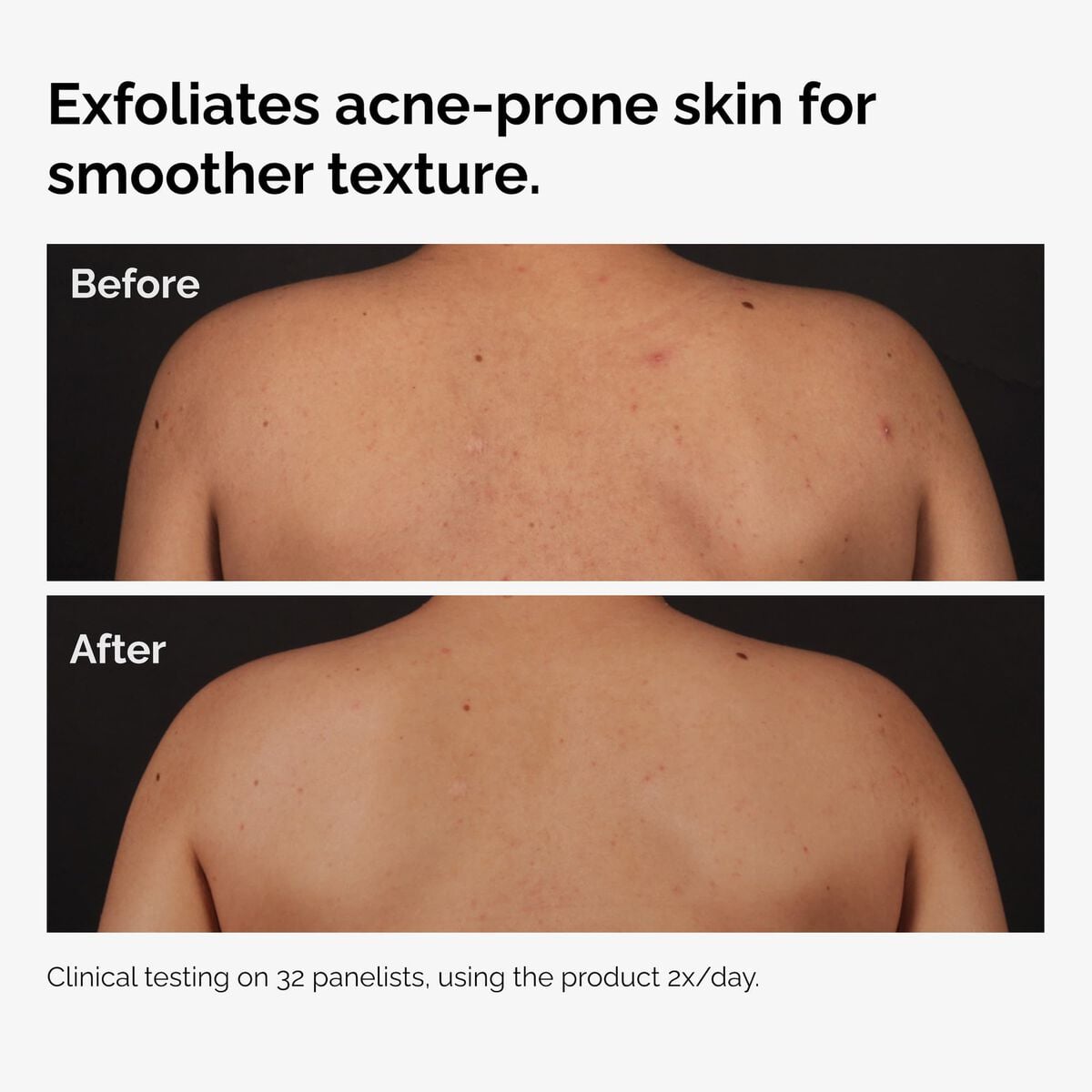 salicylic-acid-0-5-body-serum-g9 ord-salicylic-acid-body-serum-before-after-graphic-NA.jpg