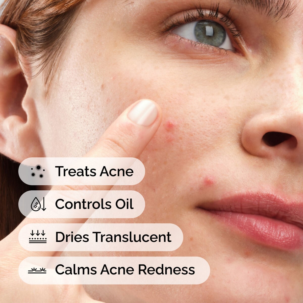 sulfur-10-powder-to-cream-concentrate-b8 ord-sulfur-10pct-powder-to-cream-concentrate-model-application-with-benefits-acne.jpg