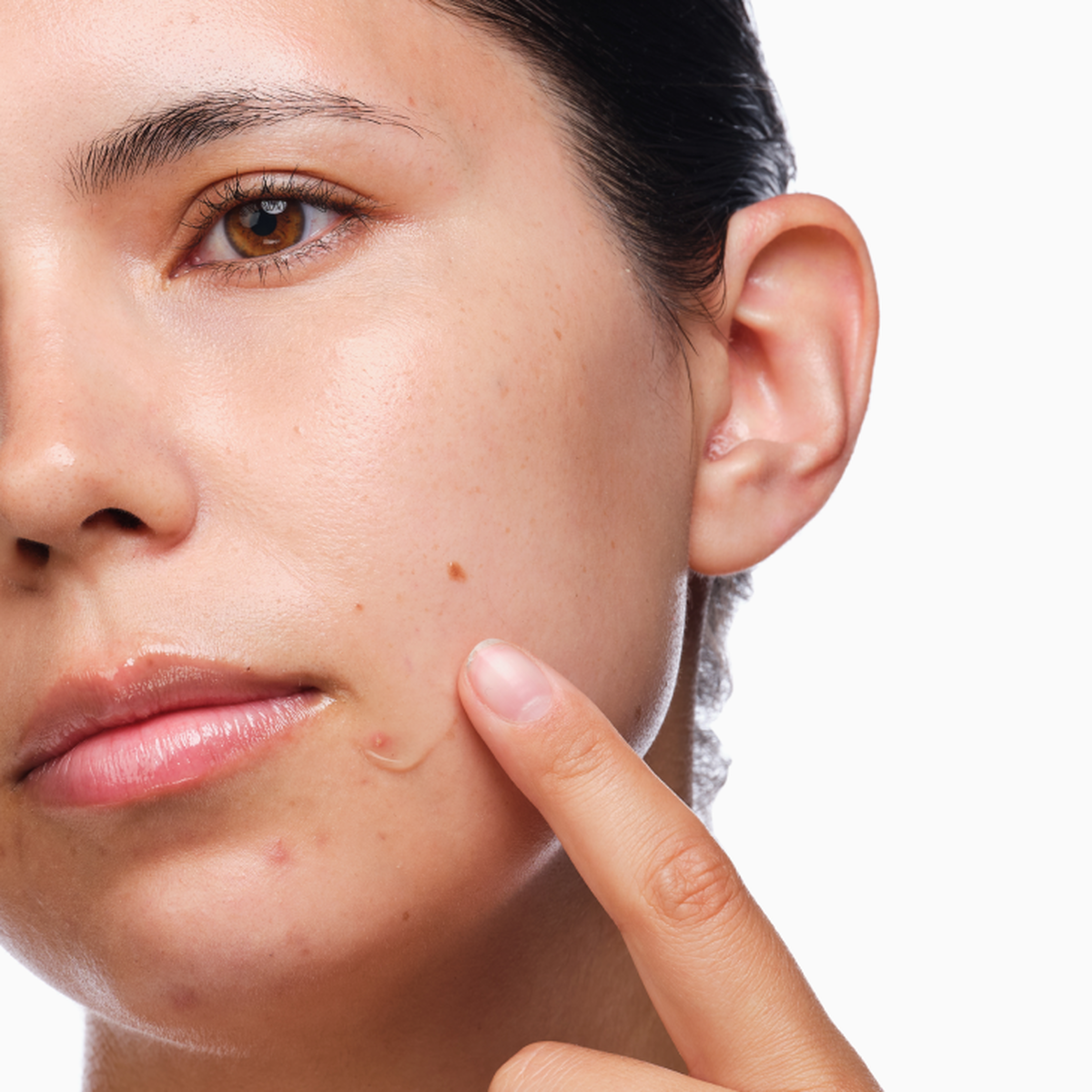 the-acne-set-l2 rdn-the-acne-set-application.png